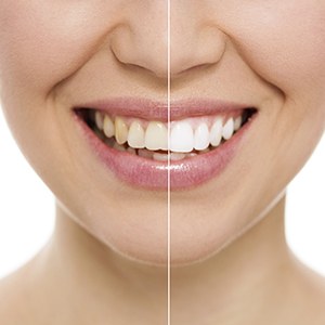 Smile before and after whitening treatment
