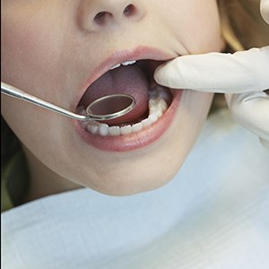 Patient examined with dental mirror