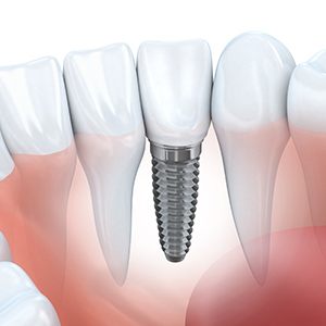Animated mock up of dental implant supported crown