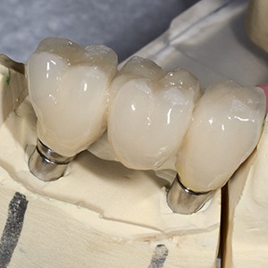 Clay model of implant supported fixed bridge