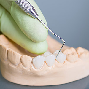 Model of smile with fixed bridge