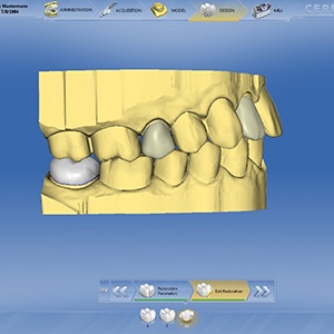 CEREC dental restoration mock-up image